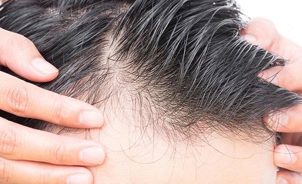 چگونه بفهمیم ریزش مو طبیعی است