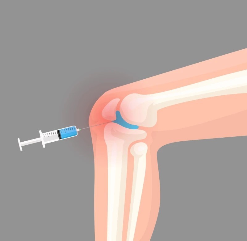 روند انجام تزریق ژل به زانو چگونه است؟
